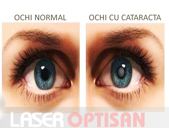 miopie după cataractă)